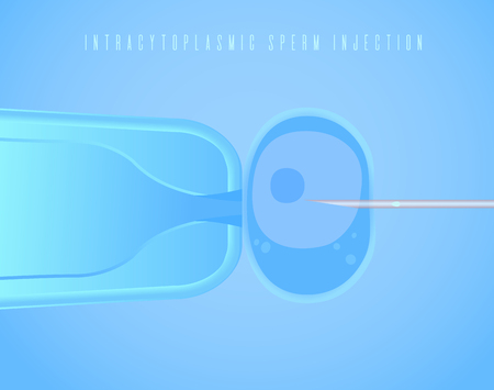 Intracytoplasmic Sperm Injection, in vitro fertilization, icsi process, IVF. Vector Illustration for web, typography magazine, medical brochure, flyer, poster.のイラスト素材