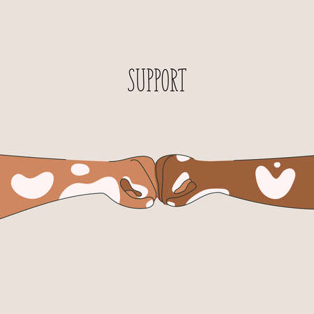 Hands of different skin color with vitiligo disease support each other with love. Flat vector illustrationのイラスト素材