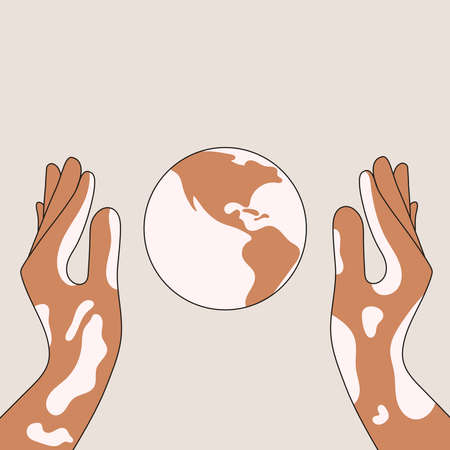 to support people with vitiligo skin diseaseのイラスト素材