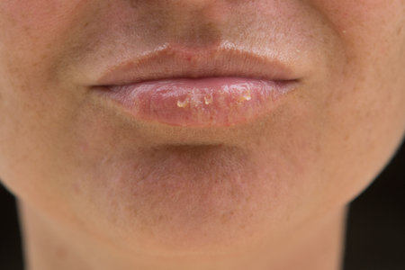Close-up of female lips suffering from herpes disease