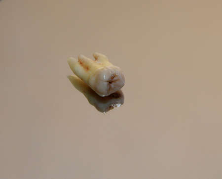 wisdom tooth on the tableの写真素材