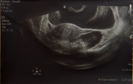 a picture of a woman's ovarian cyst