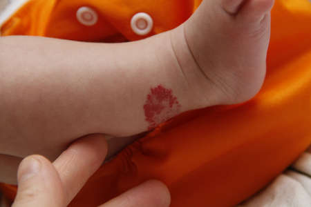 Infant hemangioma on the leg of a little boyの写真素材