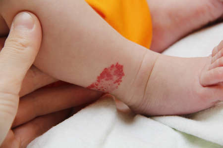 Infant hemangioma on the leg of a little boyの写真素材