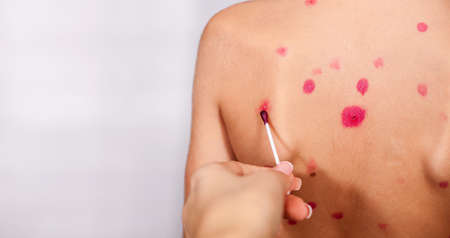 Back in a red chicken dot close-up. The concept of chickenpox. Smear pimples from chickenpox with a cotton bud. Banner. A place for text. Isolateの写真素材