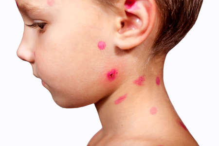 A little boy with chickenpox stands in profile on a white background. Close-up. The concept of chickenpox. Isolated.の写真素材