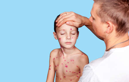A loving father checks the temperature of a boy with chickenpox. Place for text. Medicine and health of children. Banner.の写真素材