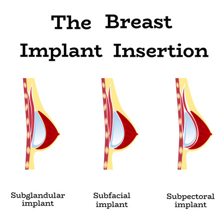 Plastic surgery of silicone breast implant,vector illustration.Female chest anatomy structure - medical wallpaper manual for implantaion,implant insertion or breast augmentation surgeryのイラスト素材