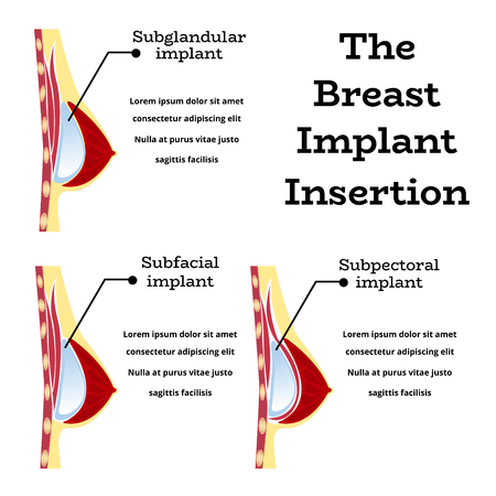 Plastic surgery of silicone breast implant,vector illustration.Female chest anatomy structure - medical wallpaper manual for implantaion,implant insertion or breast augmentation surgeryのイラスト素材