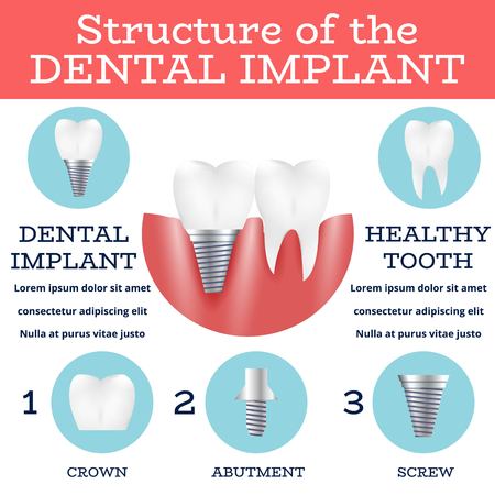 Dental Implant Structure Logo Surgery Dentistry Vector Illustration. Medical Conception for Tooth Clinic.Tooth Implant Clean Enamel on Green Blur Pattern.Implant Crown and Abutment for Dental Clinic.のイラスト素材