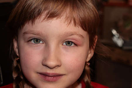 Barley in the eye. A child with barley in his eye. Inflammation of the eyelid. Human disease.の写真素材