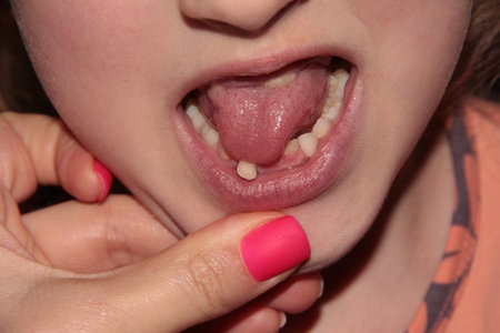 A child's mouth with a moving tooth. Pink matte nail Polish.