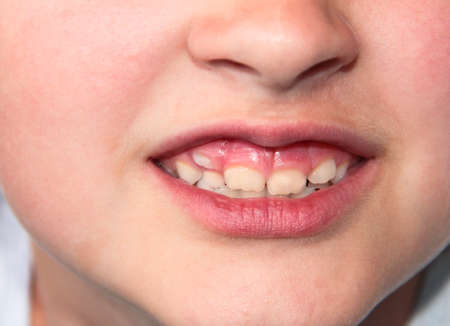 Children's teeth. The molar grows in the second row. Anomalies of tooth growth.の写真素材