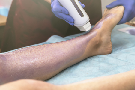 Woman having hair removal procedure on leg with wax depilatory in salon. Depilation concept.の写真素材