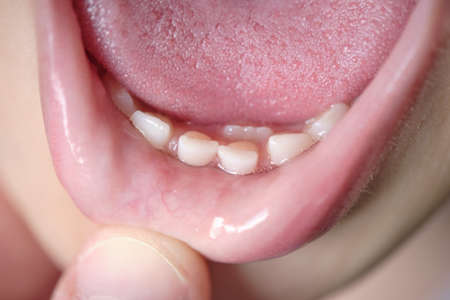 Open mouth of a child with milk teeth. Teeth in two rows. Shark tooth. The permanent incisors grew...