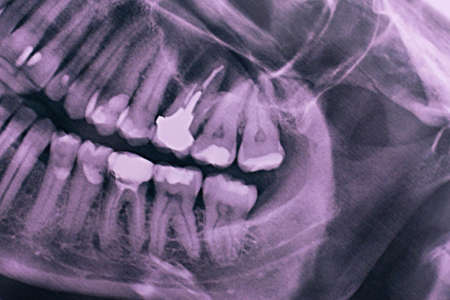 Part of a panoramic dental picture. Close-up.