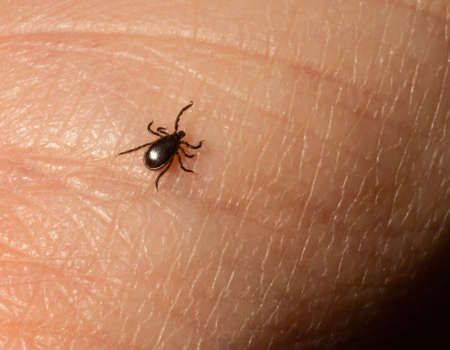 Infectious Encephalitis Ixodes Scapularis or Persulcatus Deer Tick Insect on Skin. Encephalitis...