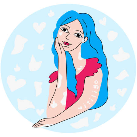 Smiling woman with vitiligo skin diseaseのイラスト素材