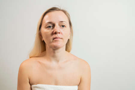 Real biorevitalization of the skin on a white background. Traces of injections of biorevitalization on the face of a woman. Traces of biorevitalization needlesの写真素材