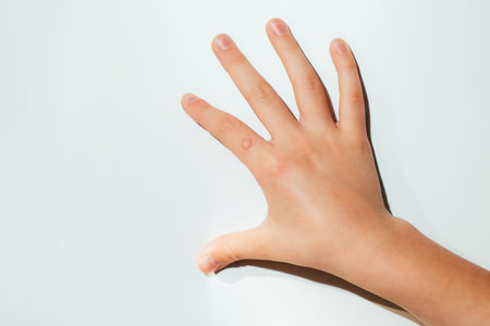 Childrens hand with a wart on a white background. Papilomavirus. View from above
