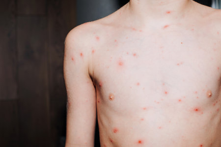 Viral diseases with a rash on the body. Chickenpox on the childs body. Treatment of chickenpox. Front viewの写真素材