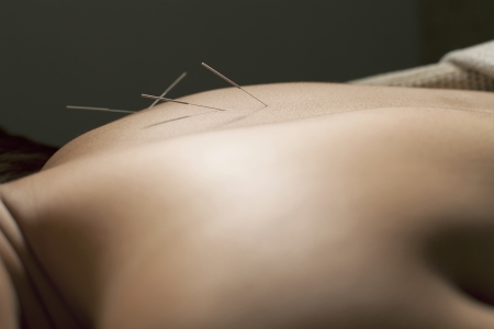 perform acupuncture spa relex thailand spa Chinese medicalの写真素材
