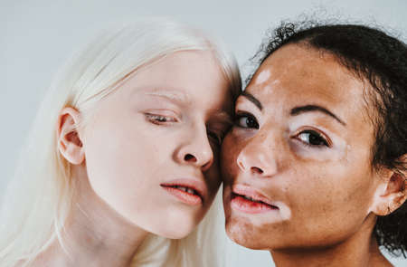 Group of multiethnic women with different kind of skin posing together in studio. Concept about body positivity and self acceptanceの写真素材