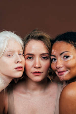 Group of multiethnic women with different kind of skin posing together in studio. Concept about body...