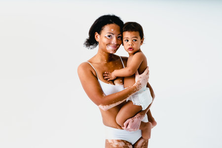 Happy black woman with vitiligo holding her baby on colored background - Young woman wearing underwear taking care of her little son - Pregnancy, motherhood, people and expectation conceptの写真素材