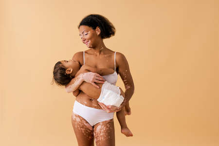 Happy black woman with vitiligo holding her baby on colored background - Young woman wearing...