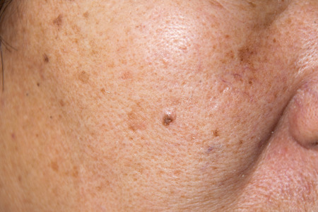 Close up Dry face skin with freckles, melasma, acne