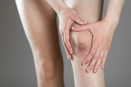 The bruise on his knee. Knee pain. The woman holds her leg. Close up.の写真素材
