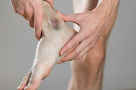 A bruise on the ankle. Scelalgia. The man holds his leg. Close up.の写真素材