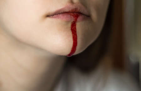 The girl with the bloody lip. Close up.の写真素材