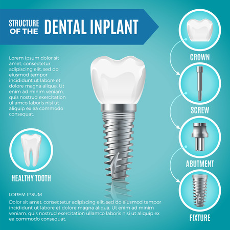 Teeth maquette. Structural elements of dental implant. Infographic for medicine posterのイラスト素材