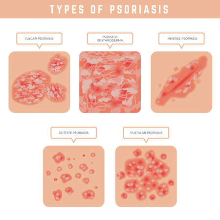 Psoriasis types. Skin problems close up medical illustrations vector set. Psoriasis problem, eczema skin disease, epidermis dermatitisのイラスト素材