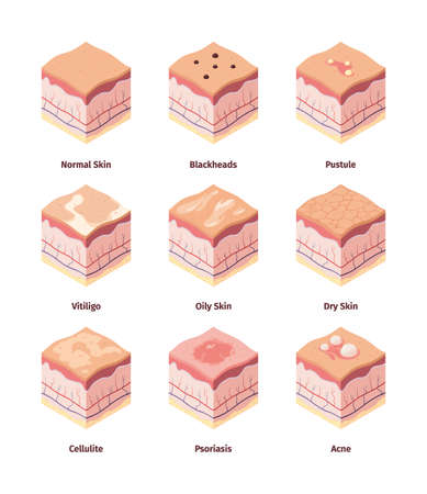 Type of skin. Dermis structure human body cross layers biological illustration cellulite dermatology peles garish vector isometric pictureのイラスト素材