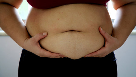 salvador, bahia / brazil - june 10, 2020: woman holds her belly where there is accumulation of abdominal cordura in the city of Salvador.のeditorial素材