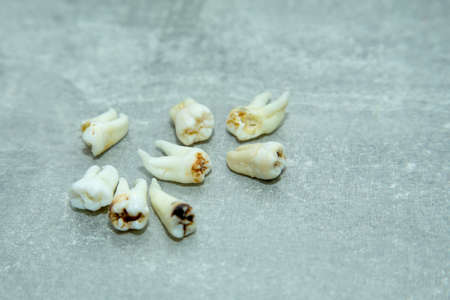 bad teeth pulled out by a dentist eight piecesの写真素材