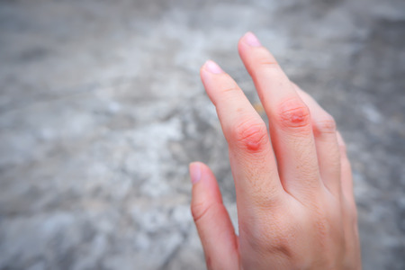 Keloid scar on woman hand. Can use for skin imperfections concepts.の写真素材