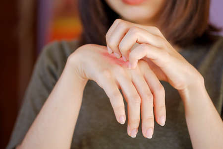 Asian woman is scratching a hand with a red rash on the back of the hand due to a foreign body...