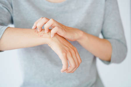 A woman scratching her arm, experiencing an allergic reaction or being stung by an insect. Skin...