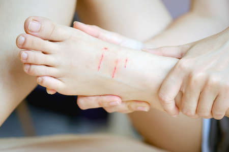 Close-up bleeding wound on the back of the foot caused by a cat scratch.の写真素材