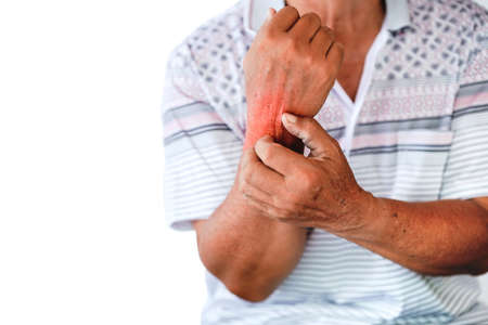 The wrist of an elderly man have red rashes, causing itching due to insect bites or allergies to...