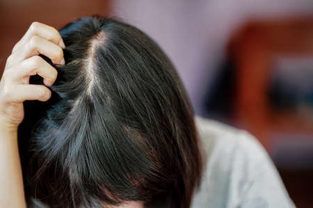 A woman has hair loss and is so thin that she can see her scalp.の写真素材