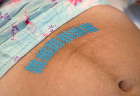 Taping a kinesiology tape on a scar after a caesarean section.の写真素材