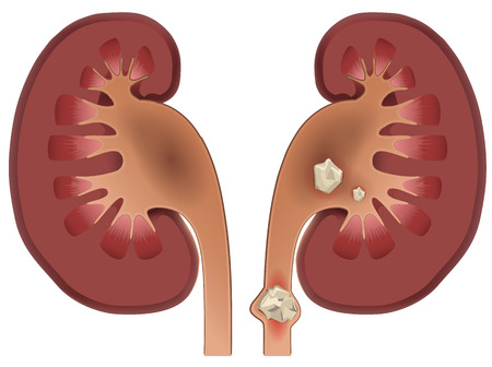 Nephrolithiasis kidney stones disease. Vector medical illustration isolated on whiteのイラスト素材