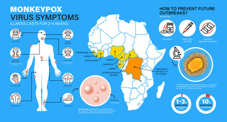 Monkeypox infographics. Monkeypox virus Symptoms. New cases of Monkeypox virus are reported in Europe and USA. Monkeypox is spreading in Europe. It cause skin infections.のイラスト素材