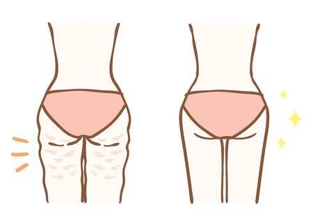Before and after cellulite removalのイラスト素材