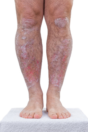 Psoriasis is a chronic inflammatory disease of the skin.Details of the legs.の写真素材